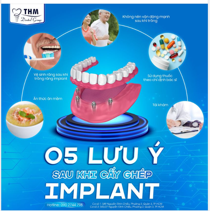 5 LƯU Ý SAU KHI CẤY GHÉP IMPLANT