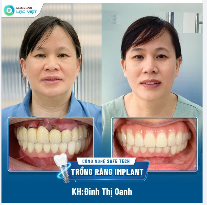 LOẠI BỎ CẦU RĂNG SỨ, TRỒNG RĂNG TOÀN HÀM TRÊN