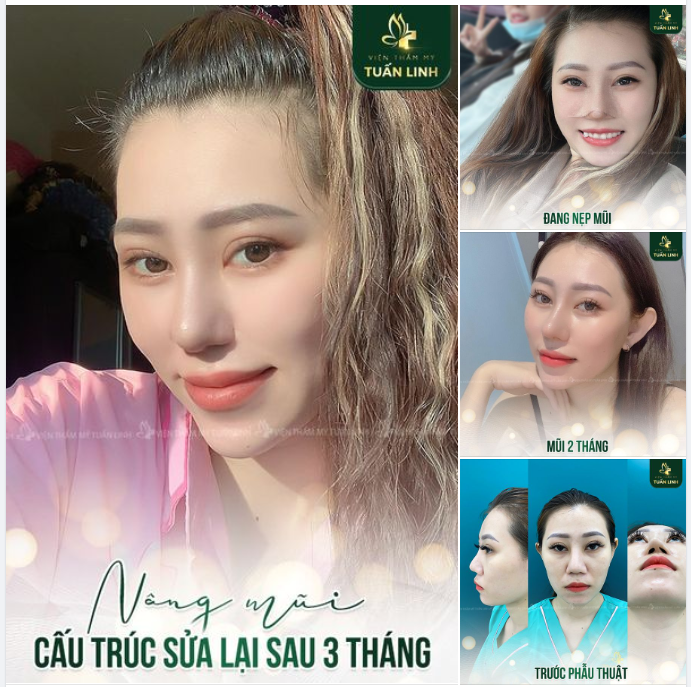 Nâng mũi cấu trúc sửa lại-Mũi vào form đẹp tự nhiên sau 3 tháng