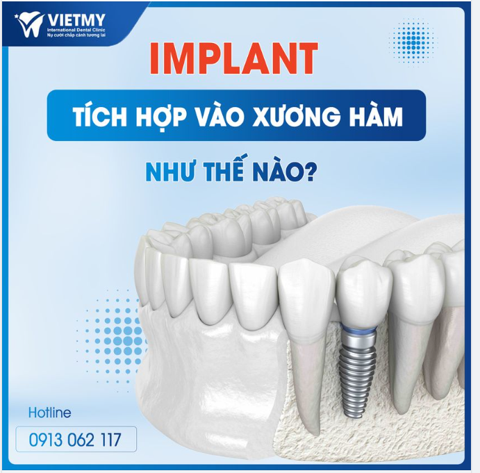 ​​​​​​​ IMPLANT TÍCH HỢP VÀO XƯƠNG HÀM NHƯ THẾ NÀO ?