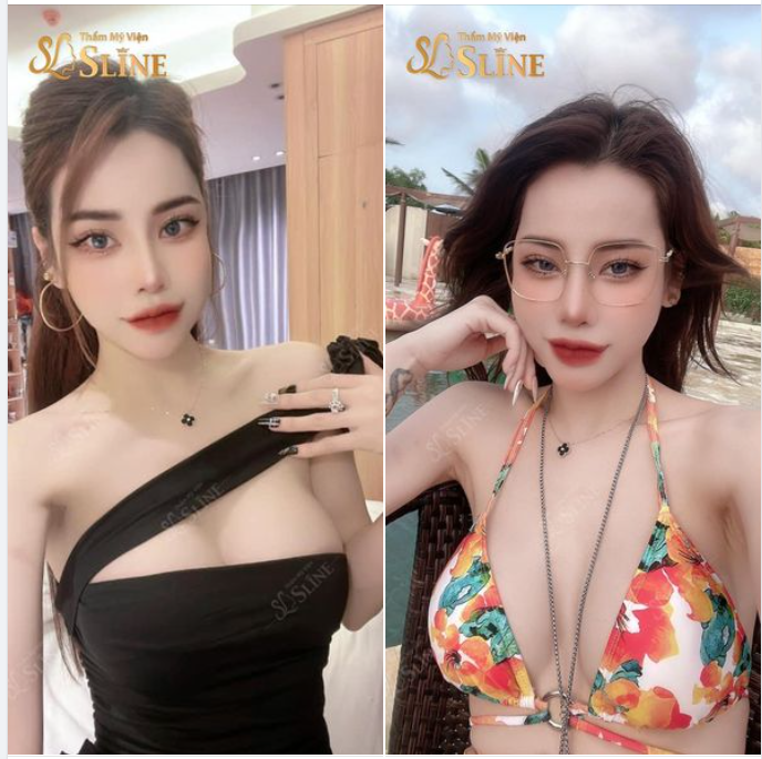 NGỰC ĐẸP CÙNG SLINE. "Vòng 1 căng tròn mềm mại, cân đối "