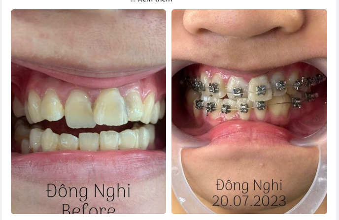 Bắt đầu xếp lại răng và chỉnh lại nụ cười cho bé