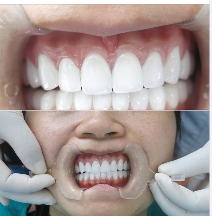 Độ bền của các loại răng sứ phổ biến hiện nay