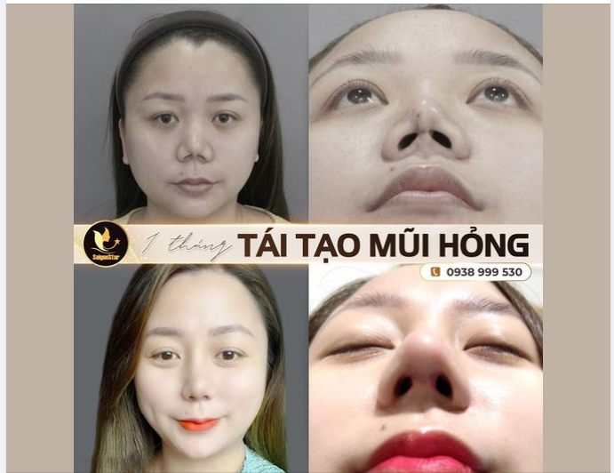 1 THÁNG TÁI TẠO MŨI HỎNG