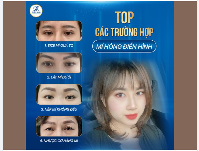 TOP CÁC TRƯỜNG HỢP MÍ HỎNG ĐIỂN HÌNH HIỆN NAY