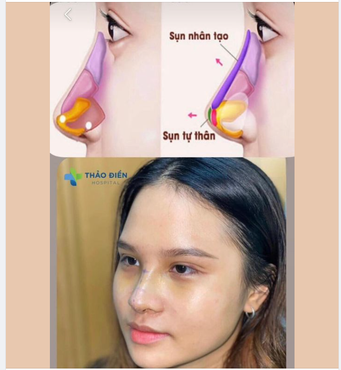 CHẮC CHẮN AI CŨNG THẮC MẮC SỤN NHÂN TẠO ĐƯỢC GHÉP VÀO MŨI NHƯ THẾ NÀO ? SỤN TỰ THÂN SẼ ĐƯỢC BỌC Ở VỊ TRÍ NÀO KHI MŨI ĐÓNG LẠI?