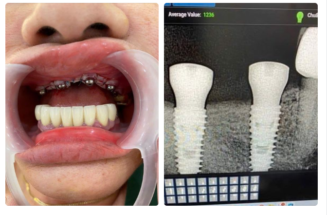 MẤT RĂNG DÙNG HÀM THÁO LẮP HAY TRỒNG IMPLANT?
