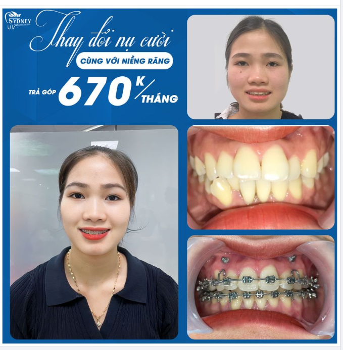 NIỀNG RĂNG SỚM THAY ĐỔI NỤ CƯỜI SỚM – TẠI SAO KHÔNG?