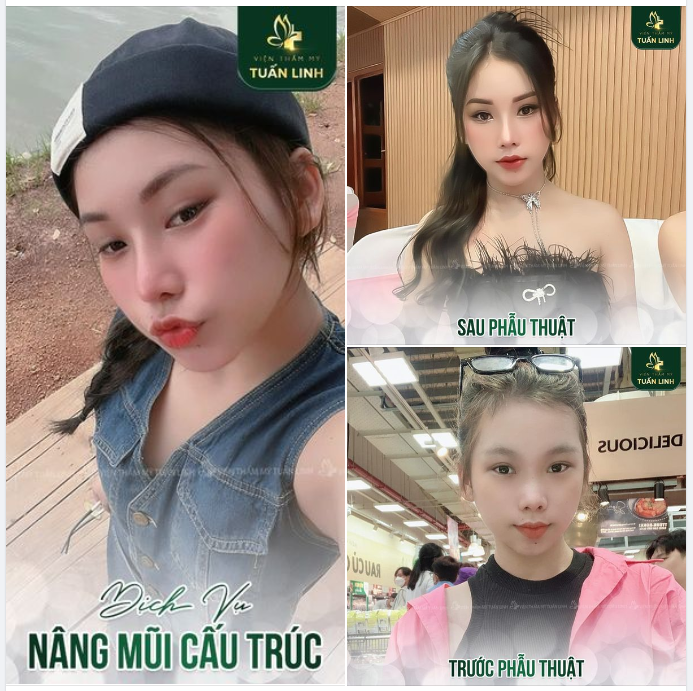 Feedback nâng mũi cấu trúc - Dáng mũi sau 3 tháng!