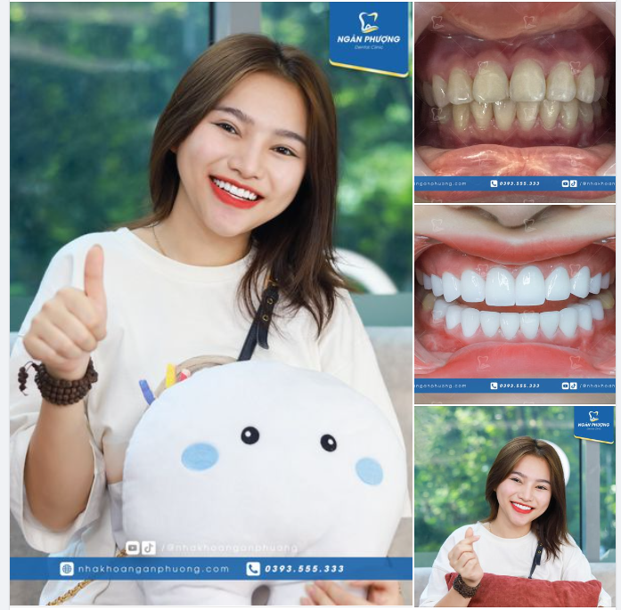Ngọc Diệp rạng rỡ với nụ cười mới. Răng sứ đã giúp bạn cải thiện dáng răng, màu răng khiến nụ cười bạn sáng và tự tin hơn rất nhiều