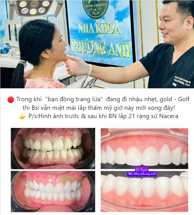 Hình ảnh trước & sau khi BN lắp 21 răng sứ Nacera