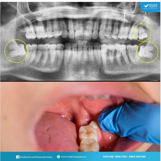 KHÔNG CHỦ QUAN VÀ TUỲ TIỆN KHI NHỔ RĂNG KHÔN