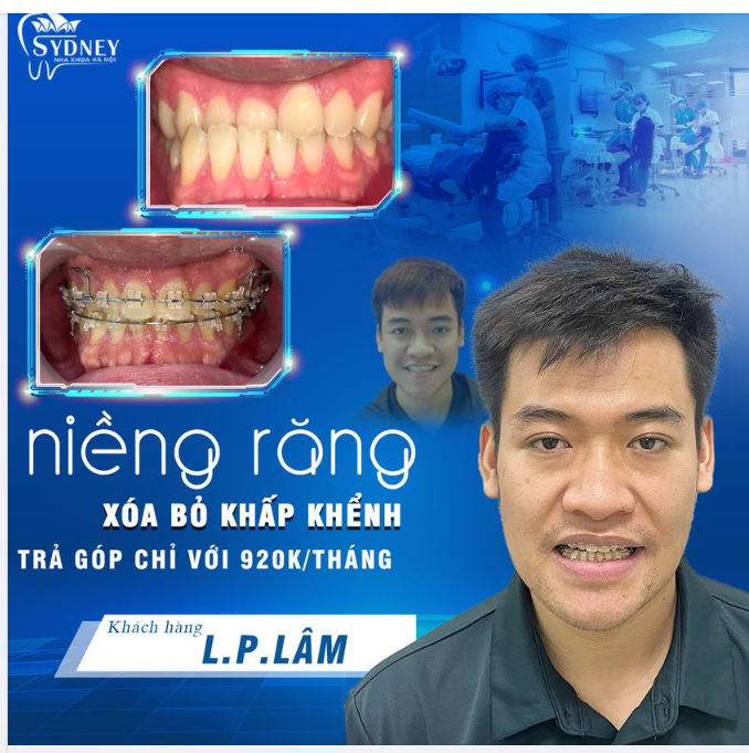 NIỀNG RĂNG MÓM TRONG BAO LÂU?