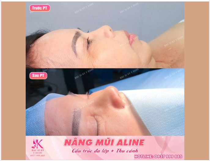 Nâng Mũi ALINE Cấu Trúc Đa Lớp