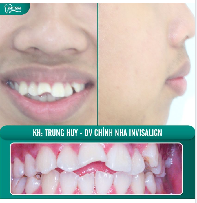 INVISALIGN: RĂNG KHẤP KHỂNH, LỆCH CÓ THỂ GIẢI QUYẾT ĐƯỢC