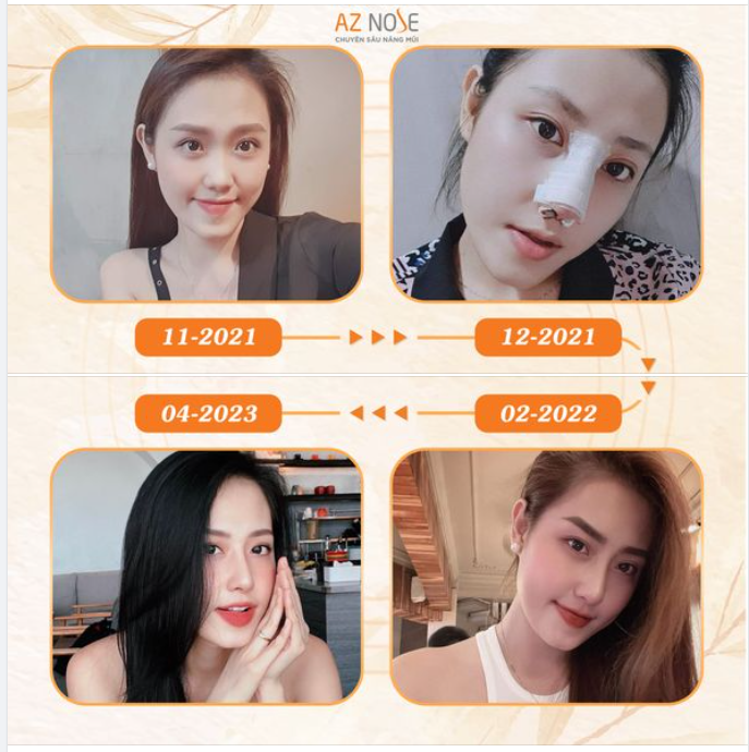 Dáng mũi chắc chắn sẽ vào form hoàn thiện hơn mỗi ngày!