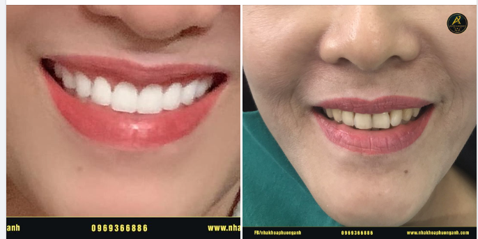 Phương pháp làm răng dài nào được áp dụng phổ biến hiện nay?