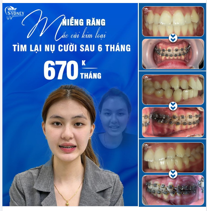 NÊN LÀM GÌ KHI MẮC CÀI BỊ BUNG TUỘT