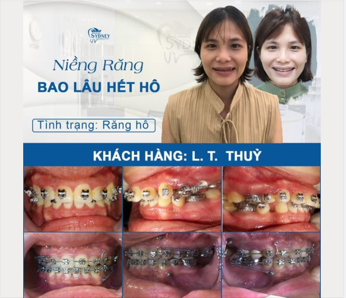 NIỀNG RĂNG HÔ BAO LÂU THÌ ĐỀU ĐẸP?