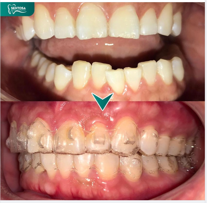 LỰA CHỌN CHỈNH NHA INVISALIGN CHƯA BAO GIỜ LÀ MUỘN!