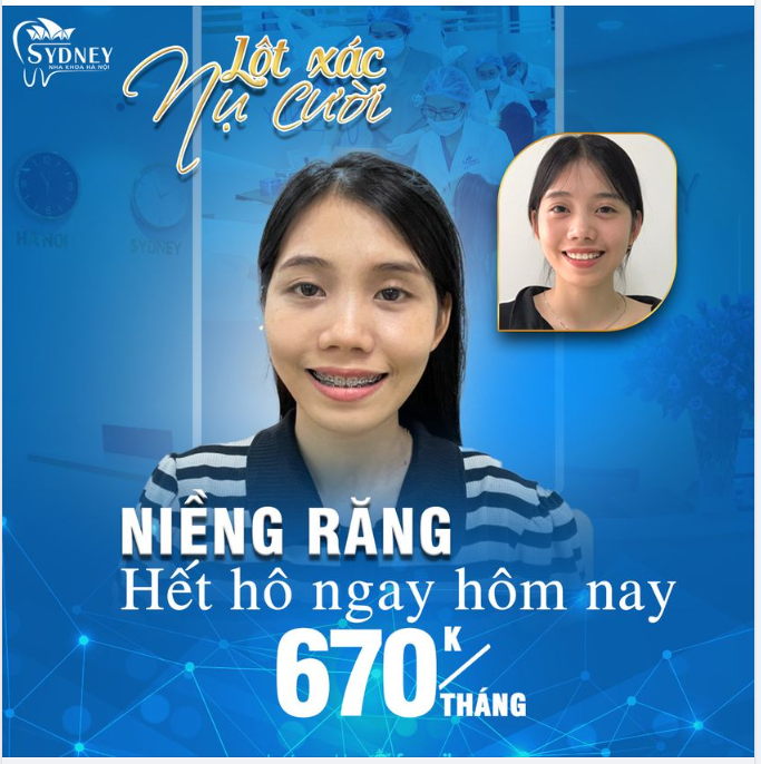 NIỀNG RĂNG MẮC CÀI KIM LOẠI – HẾT HÔ NGAY HÔM NAY
