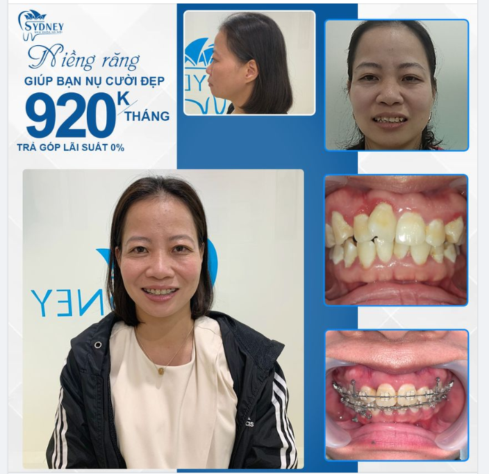GIẢI ĐÁP: NGOÀI 30 TUỔI NIỀNG RĂNG ĐƯỢC KHÔNG?