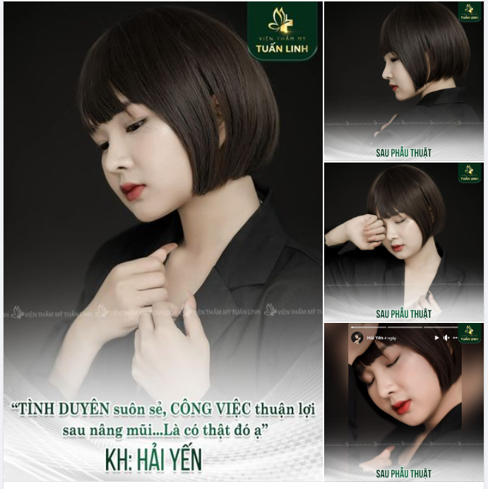 " Nâng mũi giúp gương mặt mình xinh và thanh tú hơn nên mình tự tin hơn rất nhiều. Công việc và cuộc sống gặp nhiều may mắn, thuận lợi. Tình duyên suôn sẻ...Mình hài lòng lắm"