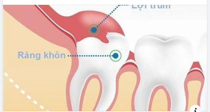 Lợi trùm răng khôn: Dấu hiệu nhận biết và cách xử trí