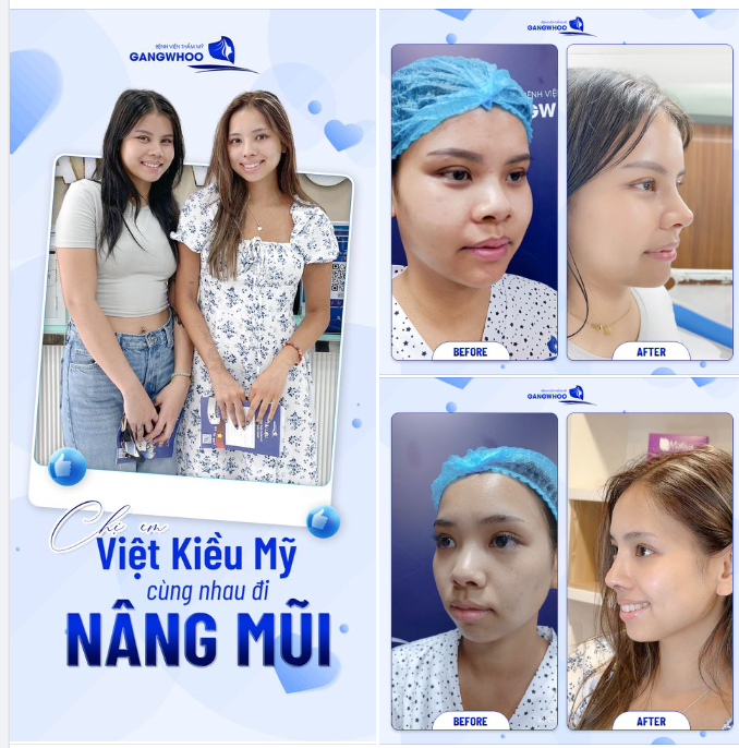 Dù ở Mỹ công nghệ làm đẹp khá phát triển thế nhưng 2 chị em Việt Kiều Mỹ Lisa và Elisa lại lựa chọn quay về Việt Nam nâng mũi
