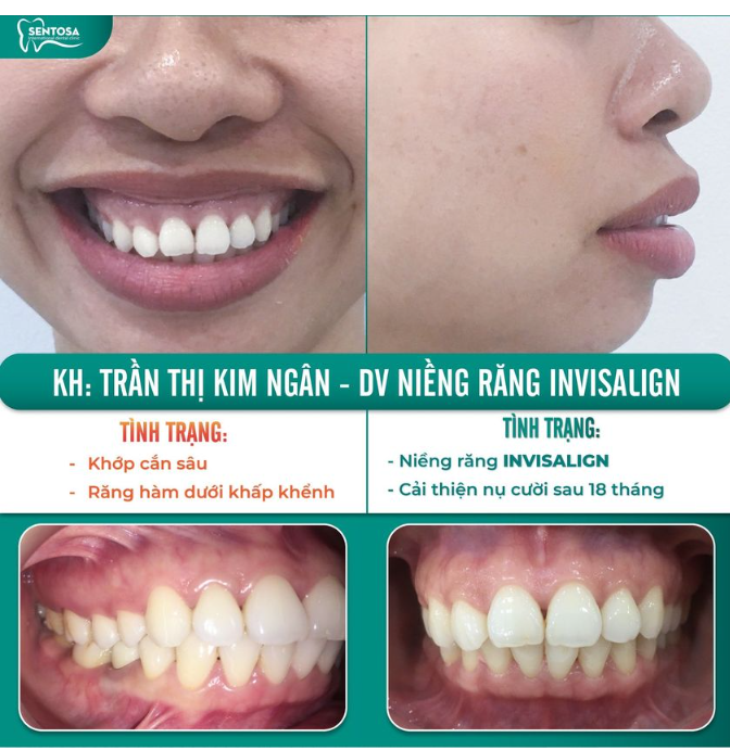 INVISALIGN: NÓI KHÔNG VỚI TỰ TI VỀ RĂNG MIỆNG