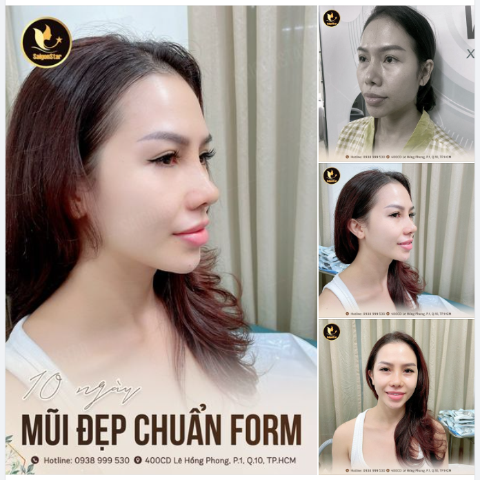 10 NGÀY MŨI ĐẸP CHUẨN FORM