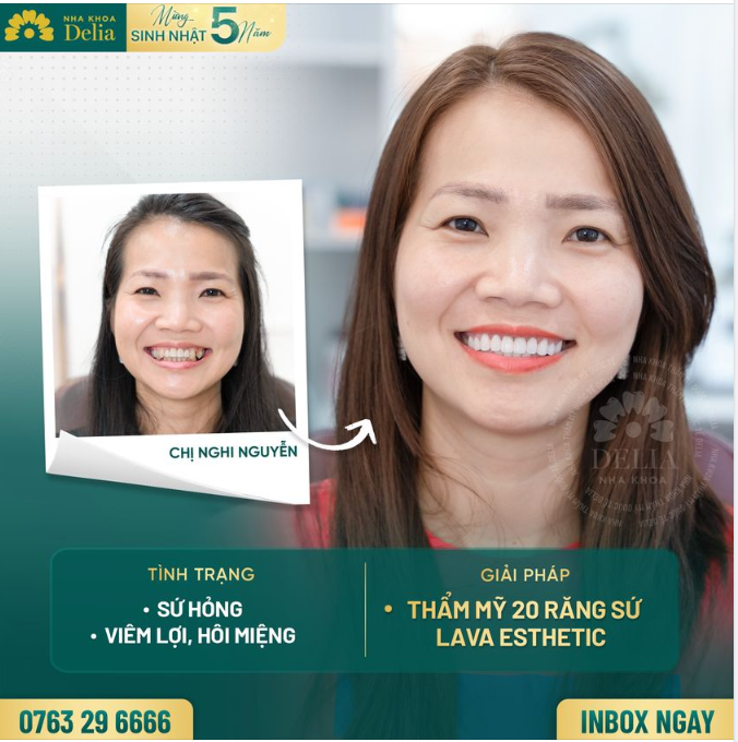 Xử lý răng sứ hỏng - Kiến tạo nụ cười mới khoẻ đẹp, rạng rỡ