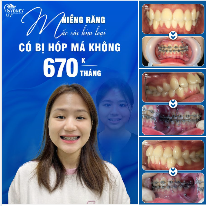 NIỀNG RĂNG CÓ BỊ HÓP MÁ KHÔNG?