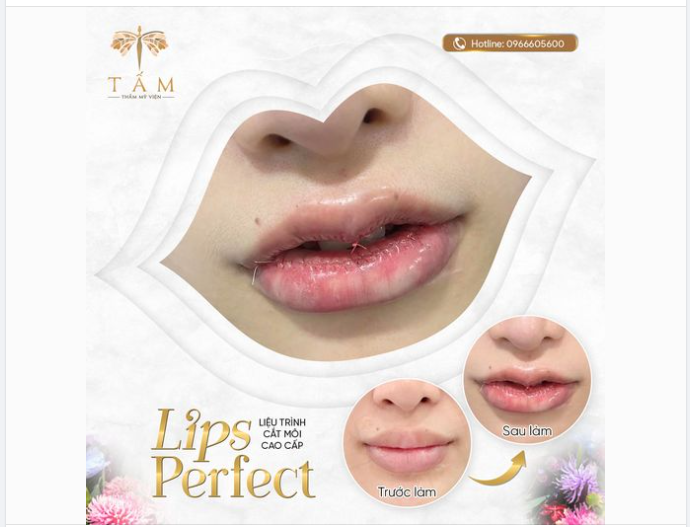 LIPS PERFECT - Tạo dáng môi ưng ý