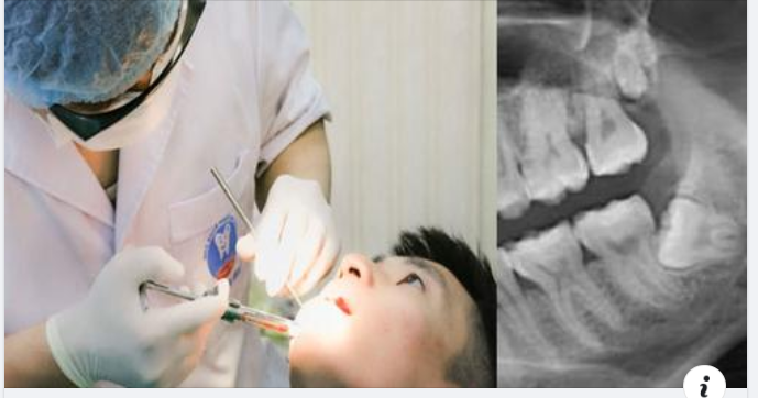 Hướng dẫn chăm sóc sau khi nhổ răng khôn