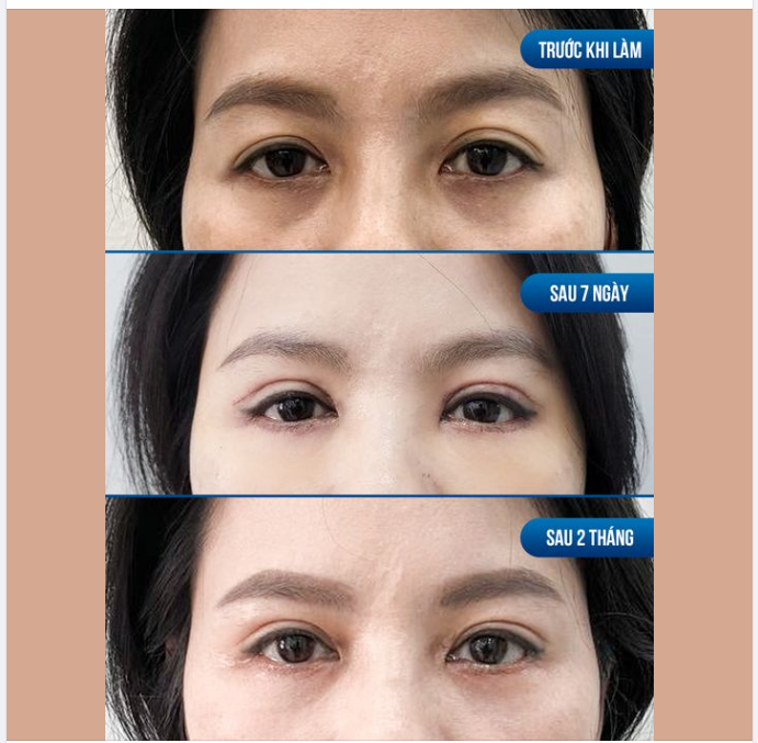 Tự ti với nếp mí không đều, bọng mắt thâm khiến chị chị khách hàng quyết định đến với Bác sĩ Tuấn Anh để thay đổi với combo cắt mí trên, cắt mí dưới và trẻ hóa mí dưới. Sau 60P thực hiện: