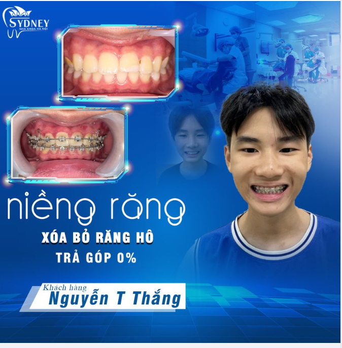 NIỀNG RĂNG HÔ CÓ MẤT NHIỀU THỜI GIAN?