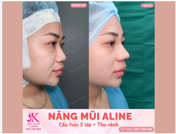 Dáng Mũi ALINE cấu trúc 2 lớp trước và ngay sau phẫu thuật