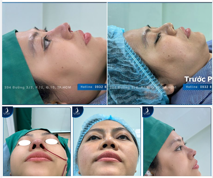 Suy sụp sau lần nâng mũi không thành công trước đó, chị khách mất niềm tin vào phẫu thuật thẩm mỹ.