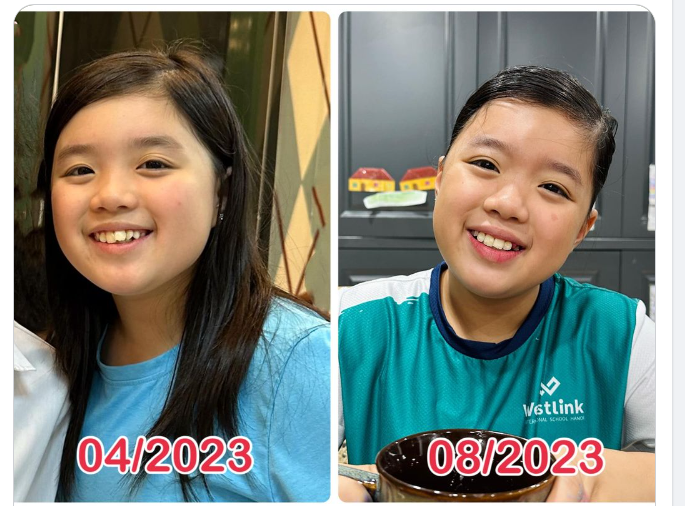 INVISALIGN: NIỀNG RĂNG THÔNG MINH CHO TRẺ