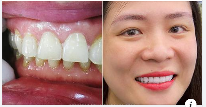 Vì Sao Viền Nướu Bị Đen Sau Khi Bọc Răng Sứ?