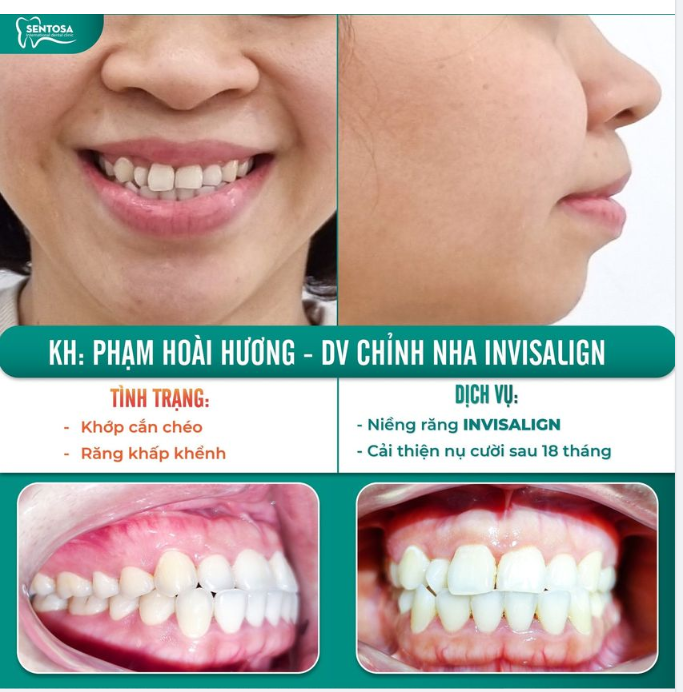 KHỚP CẮN CHÉO, RĂNG KHẤP KHỂNH ĐÃ CÓ INVISALIGN GIẢI QUYẾT