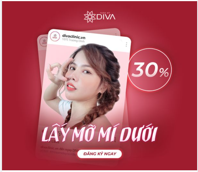 LẤY TÚI MỠ MÍ MẮT DƯỚI: TRẺ HÓA VÙNG MẮT