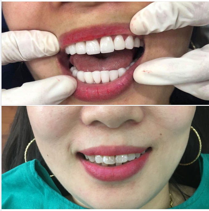 Răng sứ kim loại có mấy loại