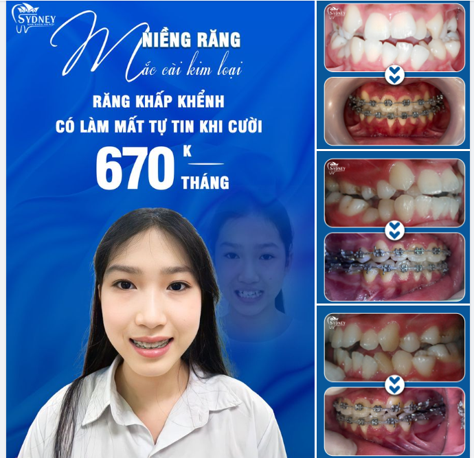 NIỀNG RĂNG MẮC CÀI KIM LOẠI CÓ LÀM BẠN MẤT TỰ TIN?