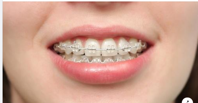 Niềng Răng Bằng Mắc Cài Sứ Có Tốt Không?