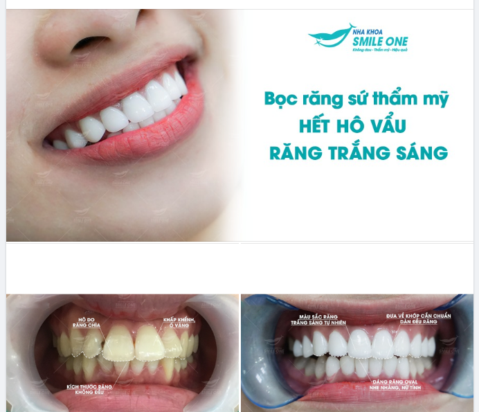 THẨM MỸ RĂNG SỨ - HẾT HÔ VẨU - RĂNG TRẮNG SÁNG!