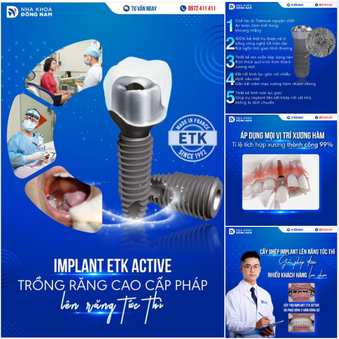 IMPLANT ETK ACTIVE THẾ HỆ MỚI - GIẢI QUYẾT MỌI TÌNH TRẠNG MẤT RĂNG