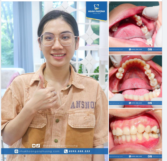 Phục hình răng 36 trên implant cho bạn Minh Nguyệt