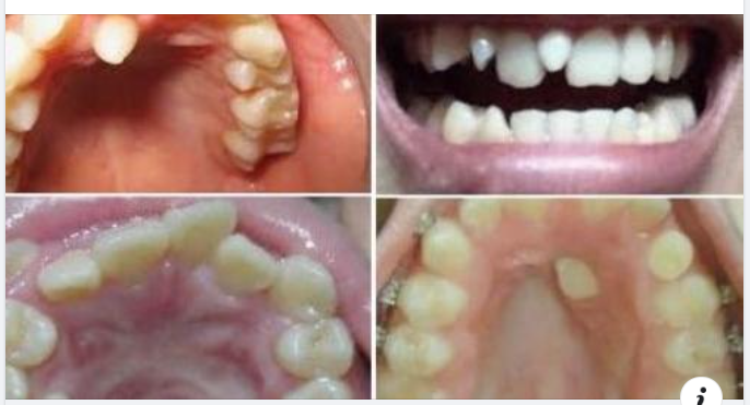 Nguyên nhân dẫn đến răng mọc thừa chèn vào 2 răng cửa?